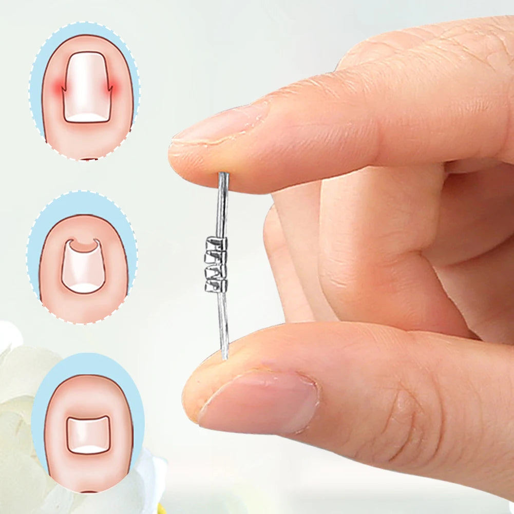 Ingrown Toenail Correction Clip
