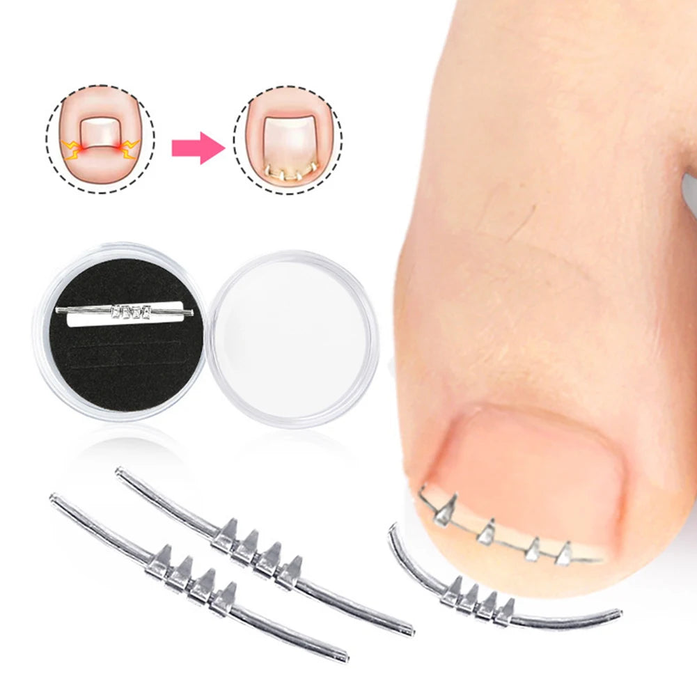 Ingrown Toenail Correction Clip