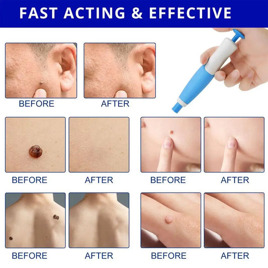 Skin Tag Remover Banding Tool