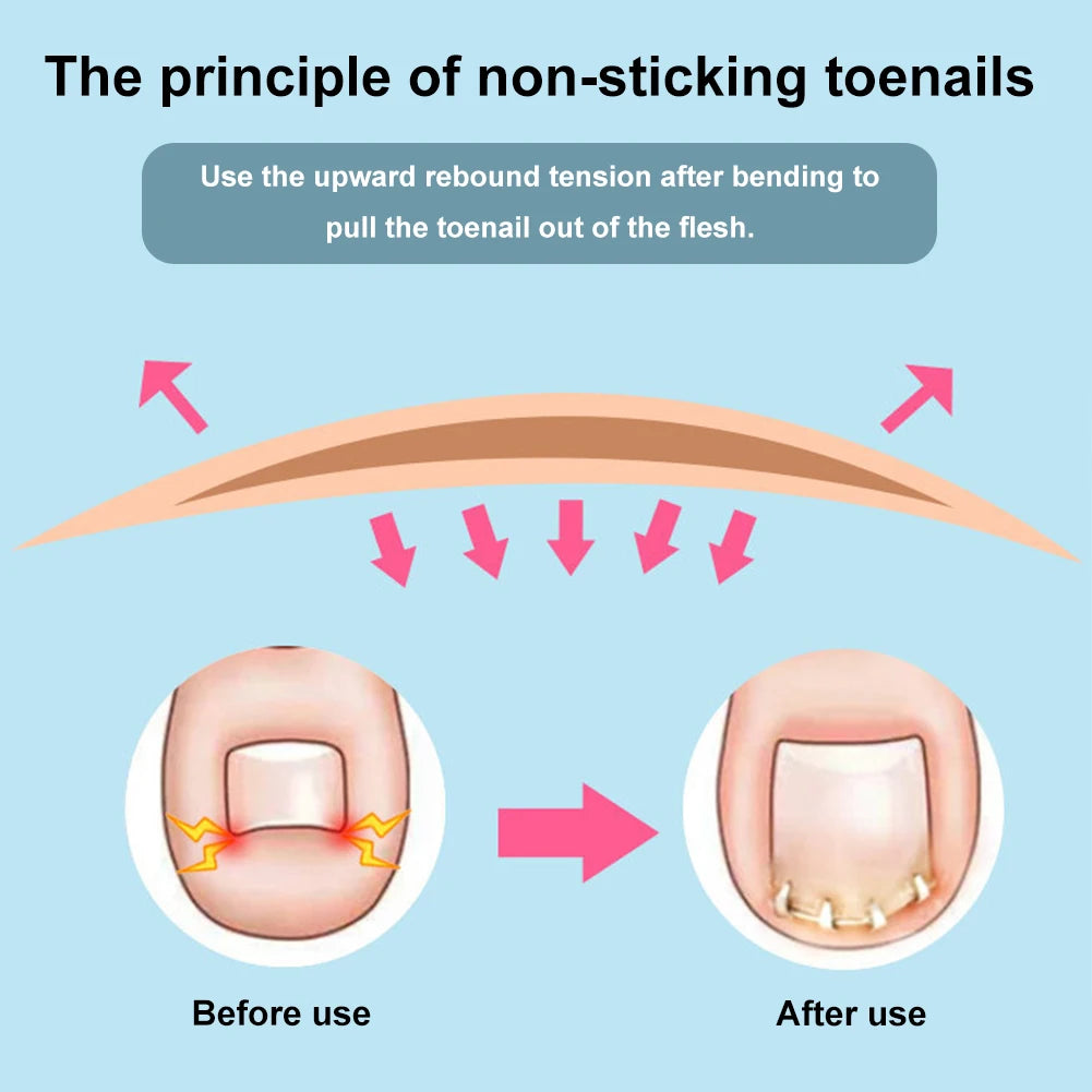 Ingrown Toenail Correction Clip